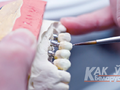 Ортопедическая стоматология - протезирование зубов