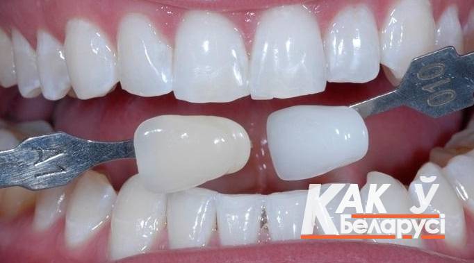 Отбеливание зубов